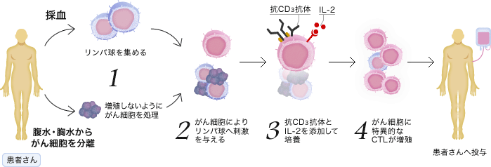 (採血 -> 1.リンパ球を集める)(腹水・胸水からがん細胞を分離 -> 1.増殖しないようにがん細胞を処理) -> 2.がん細胞によりリンパ球へ刺激を与える -> 3.抗CD抗体とIL-2を添加して培養 -> 4.がん細胞に特異的なCTLが増殖 -> 患者さんへ投与