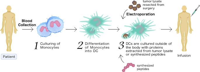[Patient]Blood Collection -> 1.Culturing of Monocytes -> 2.Differentation of Monocytes into DC -> 3.DCs are cultured outside of the body with proteins extracted from tumor lysate or synthesized peptides(tumor lysate resected from surgery, synthesized peptides) -> Infusion