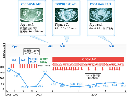 症例報告_卵巣癌