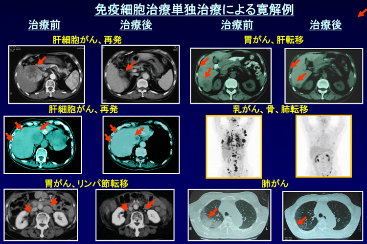 免疫細胞治療単独治療による寛解例