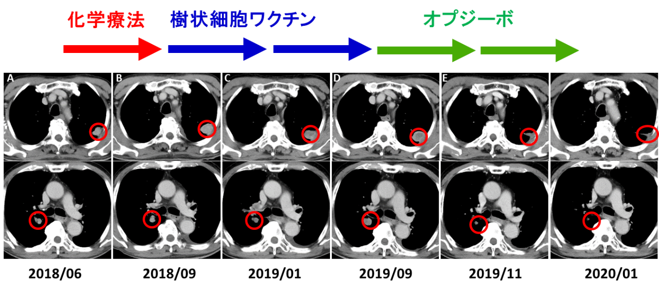 免疫細胞治療とオプジーボ