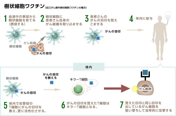 樹状細胞ワクチン療法