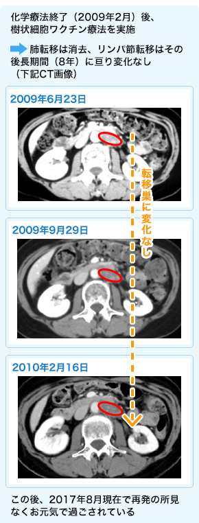 卵巣がんに対する免疫療法