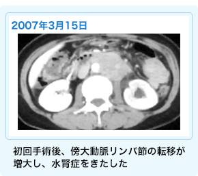 卵巣がんに対する免疫療法