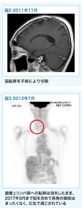 卵巣がんに対する免疫療法