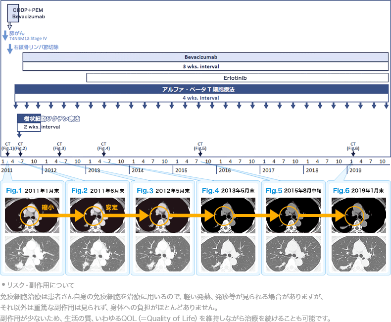 肺がんに対する免疫療法case16