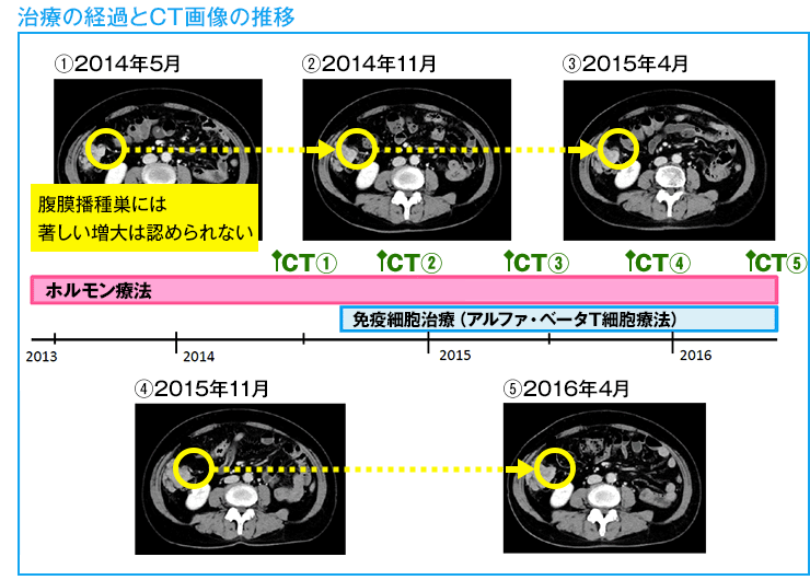 治療の経過とCT画像の推移