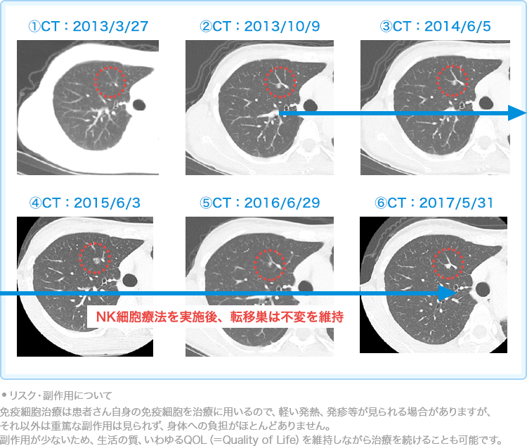 舌がんに対する免疫療法