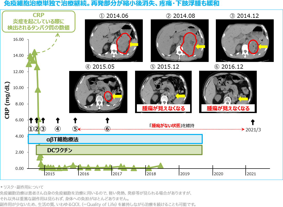 免疫細胞治療単独で治療継続。再発部分が縮小、疼痛・下肢浮腫も症状緩和