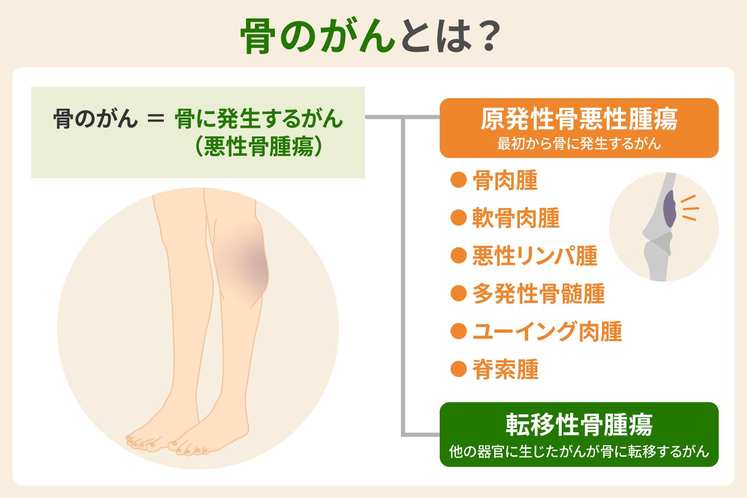 骨のがんとは？