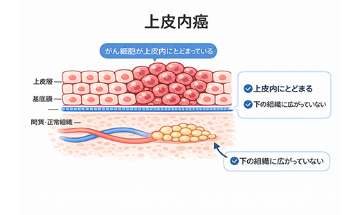 上皮内がんの種類と特徴を徹底解説 進行・検査・治療・予防まで網羅