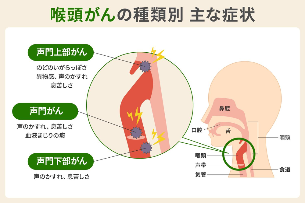 喉頭がんの種類別 主な症状