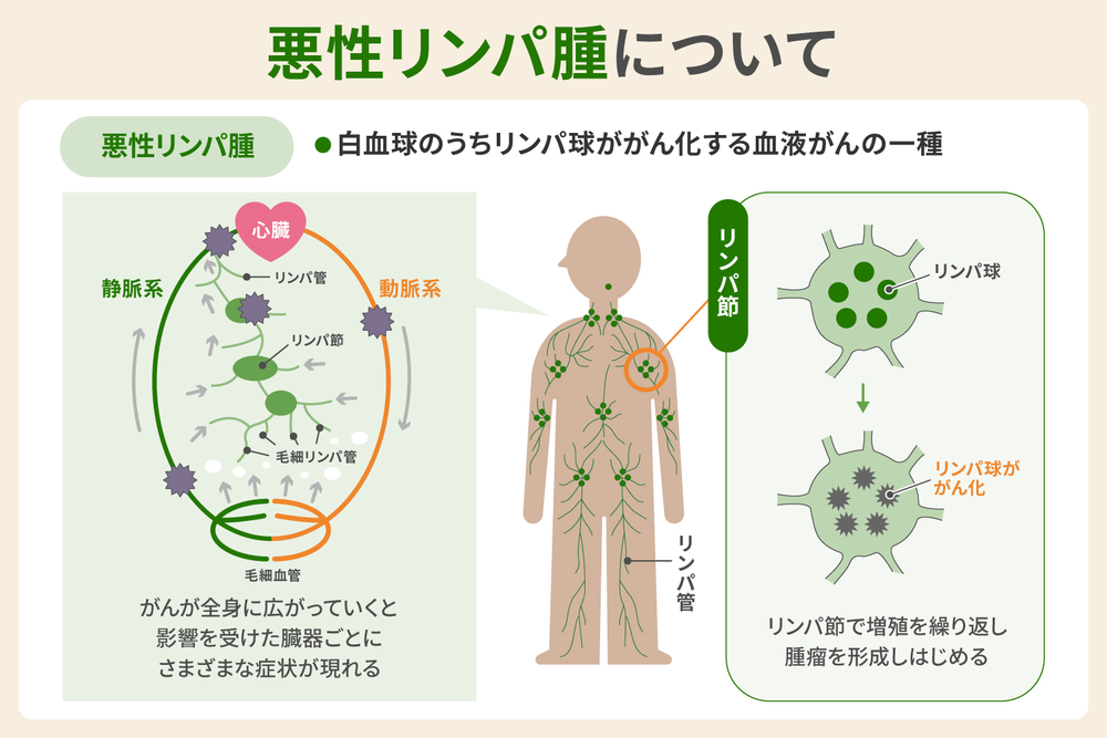 悪性リンパ腫について