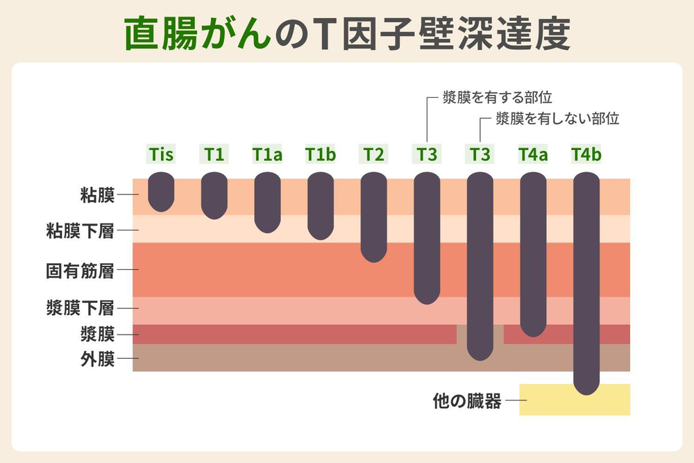 直腸がんのT因子 壁深達度