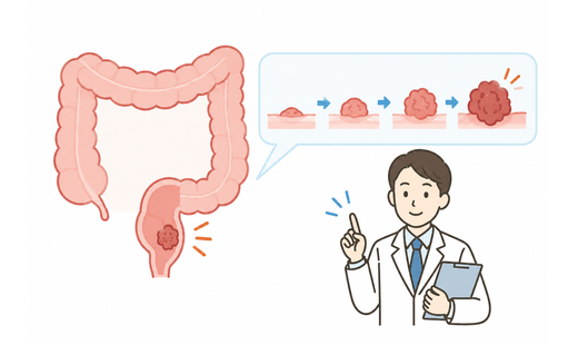 直腸がんの進行速度はどのくらい? スピードを左右する要因や主な治療法について解説