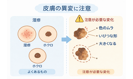 皮膚がんはどのような症状が出る?種類別の特徴や早期発見の重要性、治療法を解説
