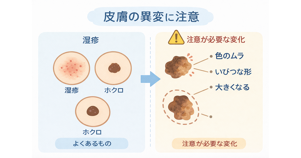 皮膚がんはどのような症状が出る？種類別の特徴や早期発見の重要性