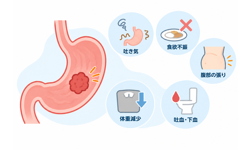 胃がんのステージ4とはどういう状態? 定義や主な症状、検査方法、治療法を解説