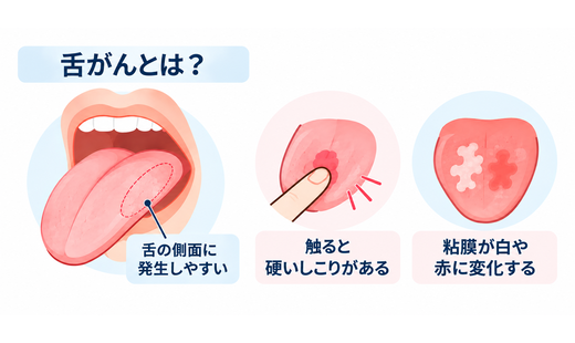 舌がんの初期症状とは? 口内炎との違いやステージ別の症状、治療方法について解説