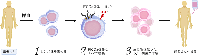 採血 -> 1.リンパ球を集める 2.抗CD抗体とIL-2で培養 3.主に活性化したαβT細胞が増殖 -> 患者さんへ投与