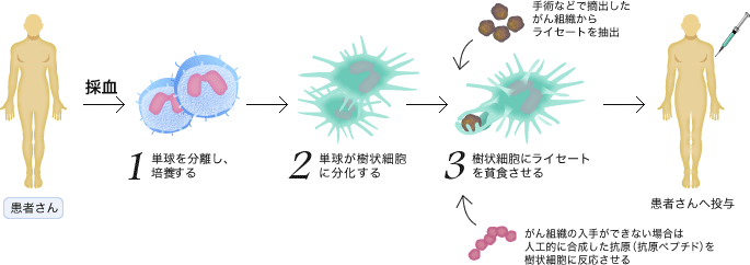 採血 -> 1.単球を分離し、培養する -> 2.単球が樹状細胞に分化する -> 3.樹状細胞にライセートを貧食させる(手術などで摘出したがん組織からライセートを抽出, がん組織の入手ができない場合は人工的に合成した抗原（抗原ペプチド）を樹状細胞に反応させる) -> 患者さんへ投与