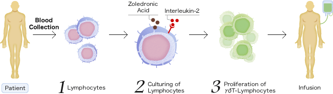 [Patient]Blood Collection -> 1.Lymphocytes -> 2.Culturing of Lymphocytes -> 3.Proliferation of γδT-Lymphocytes -> Infusion