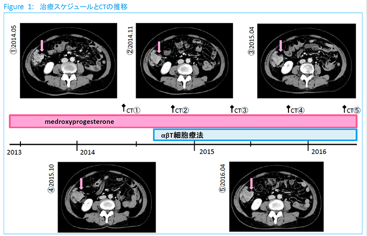 Figure1:治療スケジュールとCTの推移