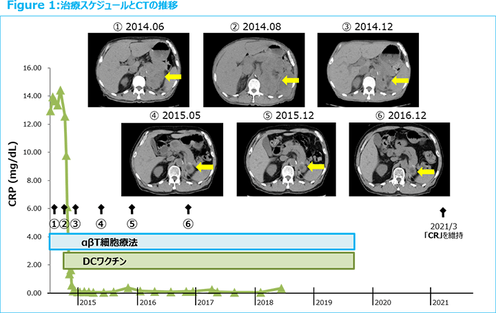 Figure1:治療スケジュールとCTの推移