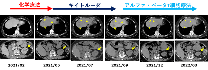 化学療法→キイトルーダ→アルファ・ベータT細胞療法