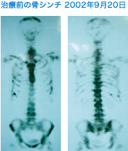 治療前の骨シンチ