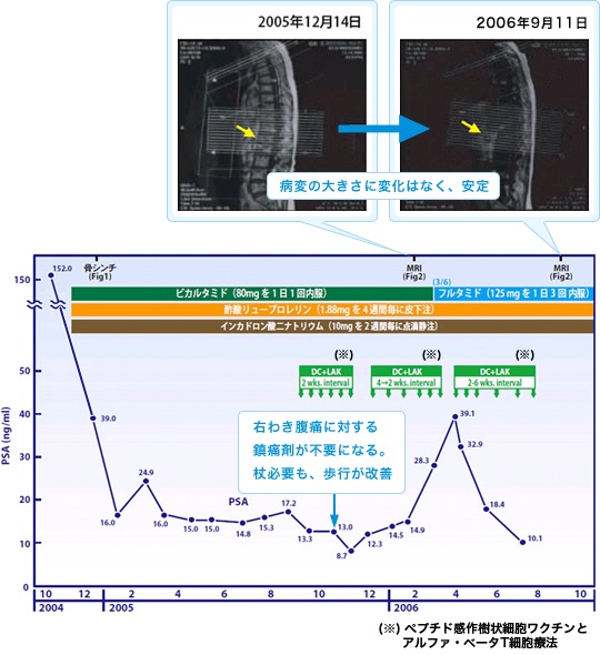 前立腺がんに対する免疫療法case15
