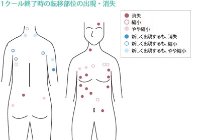 悪性黒色腫（メラノーマ）に対する免疫療法case17_2