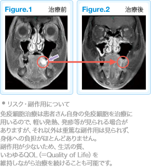 頭頸部がんに対する免疫療法case21