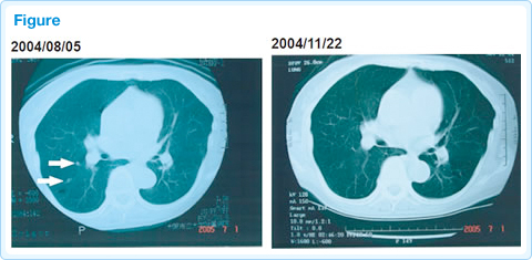 大腸（直腸）がんに対する免疫療法case22