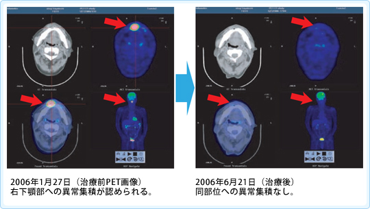 悪性リンパ腫に対する免疫療法case23