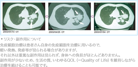 腎臓がんに対する免疫療法case24