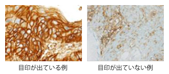 肺がんに対する免疫療法case_16_1