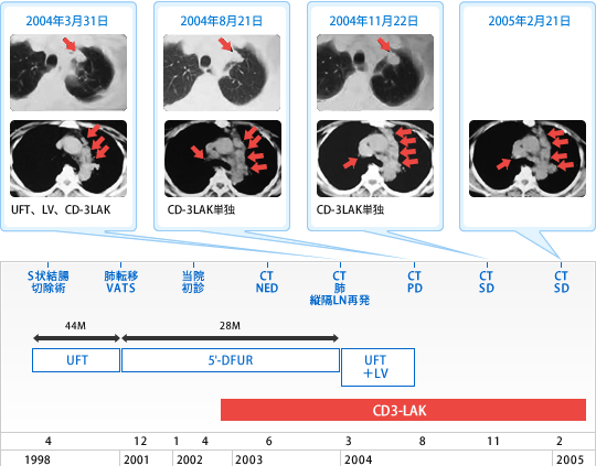 大腸（結腸）がんに対する免疫療法colon_cancer