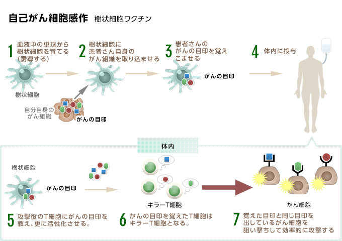 自己がん細胞感作樹状細胞ワクチン