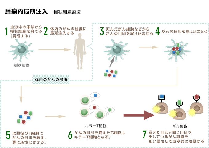 腫瘍内局注樹状細胞ワクチン