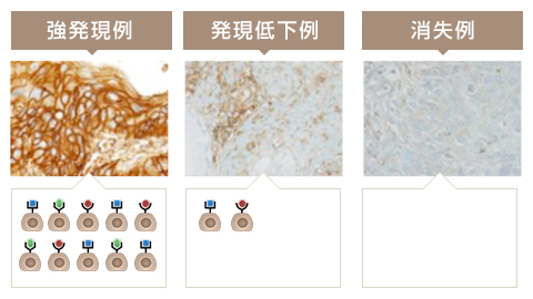 左が最も多く発現している例、真ん中が発現低下している例、右がまったく発現していない例です。