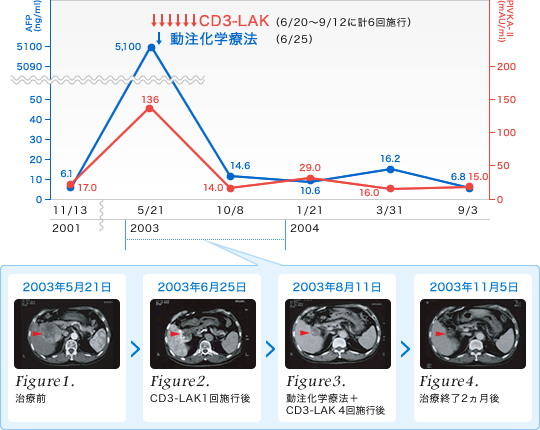 肝臓がんに対する免疫療法liver_cancer