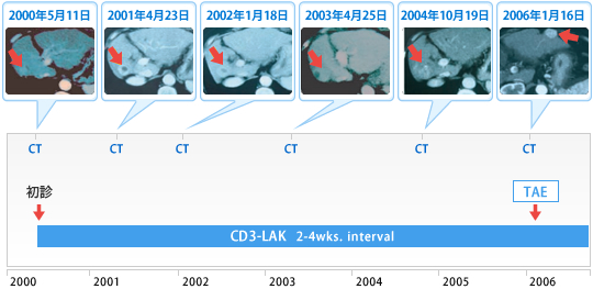 肝臓がんに対する免疫療法liver_cancer3