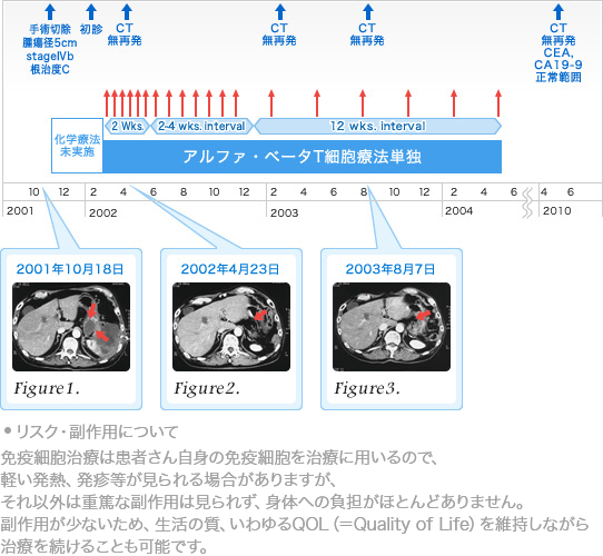 膵臓がんに対する免疫療法pancreatic_cancer2