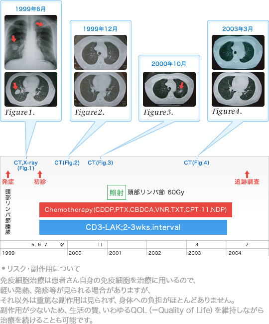 肺がんに対する免疫療法test3