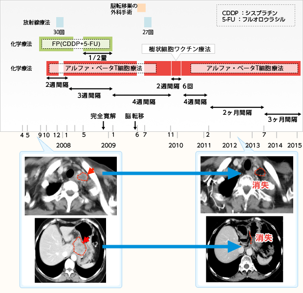 食道がんに対する免疫療法case026